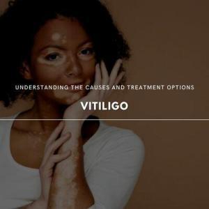 vitiligo 101