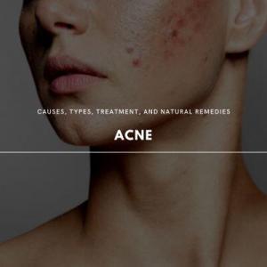 acne 101