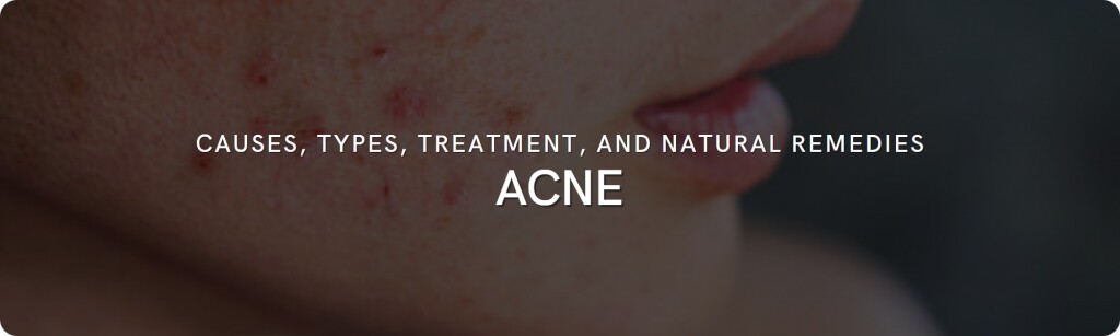 acne fact tips